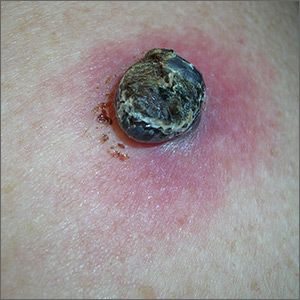 Black lesion on arm