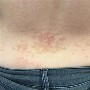 Edematous, reticulated rash on back