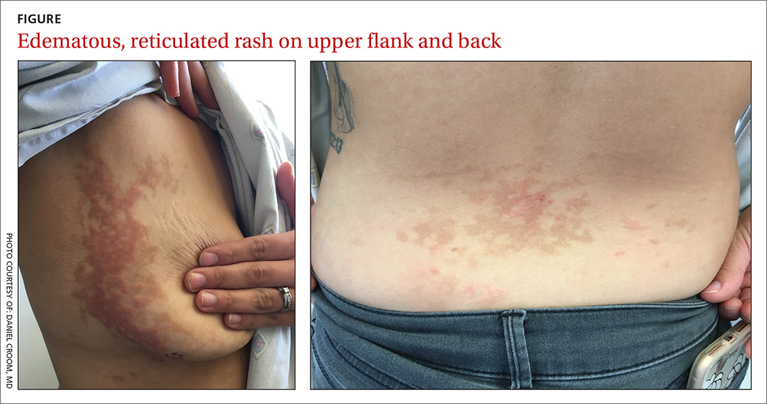 Pruritic rash on trunk  MDedge Family Medicine