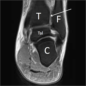 High ankle sprains: Easy to miss, so follow these tips