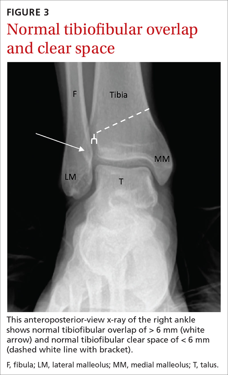 Normal tibiofibular overlap and clear space