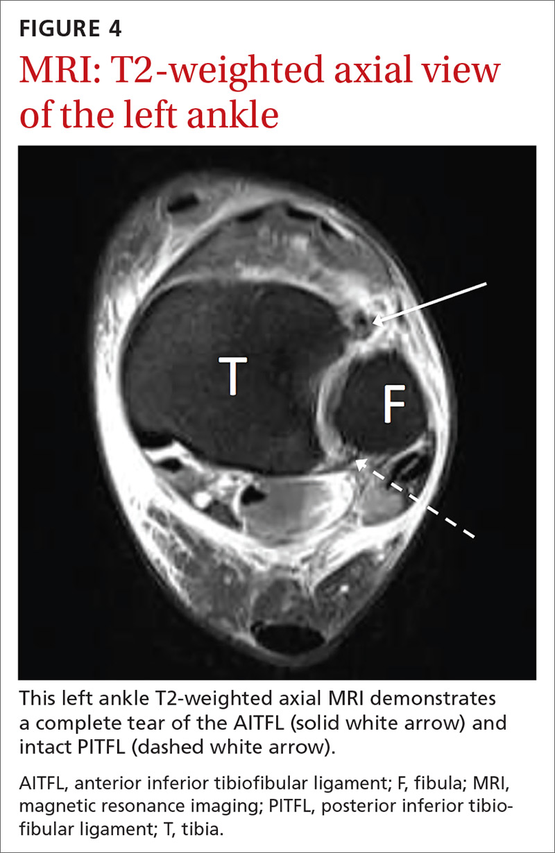 MRI: T2-weighted axial view of the left ankle