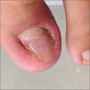 Patient’s left hallux at presentation