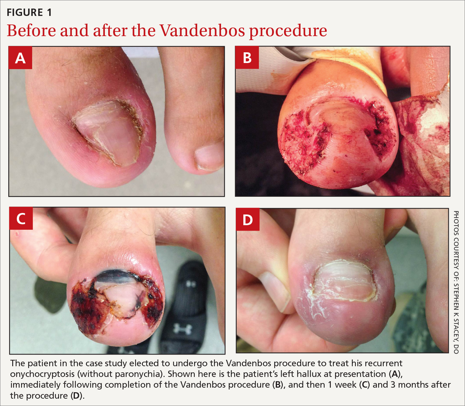 A practical guide to the care of ingrown toenails | MDedge Family Medicine