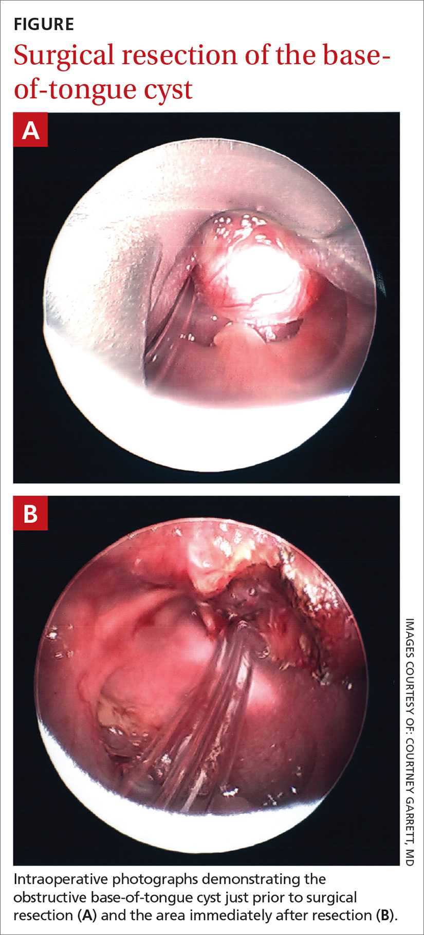 Surgical resection of the base-of-tongue cyst