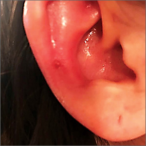 Red, swollen, and tender ear