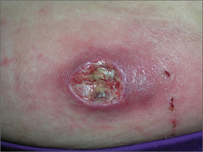 Erythema on abdomen