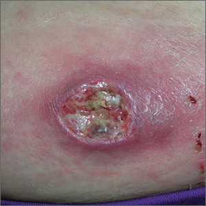 Erythema on abdomen