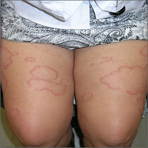 Geometric rash on arms and legs