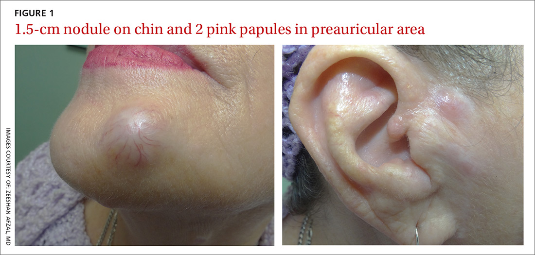 1.5-cm nodule on chin and 2 pink papules in preauricular area