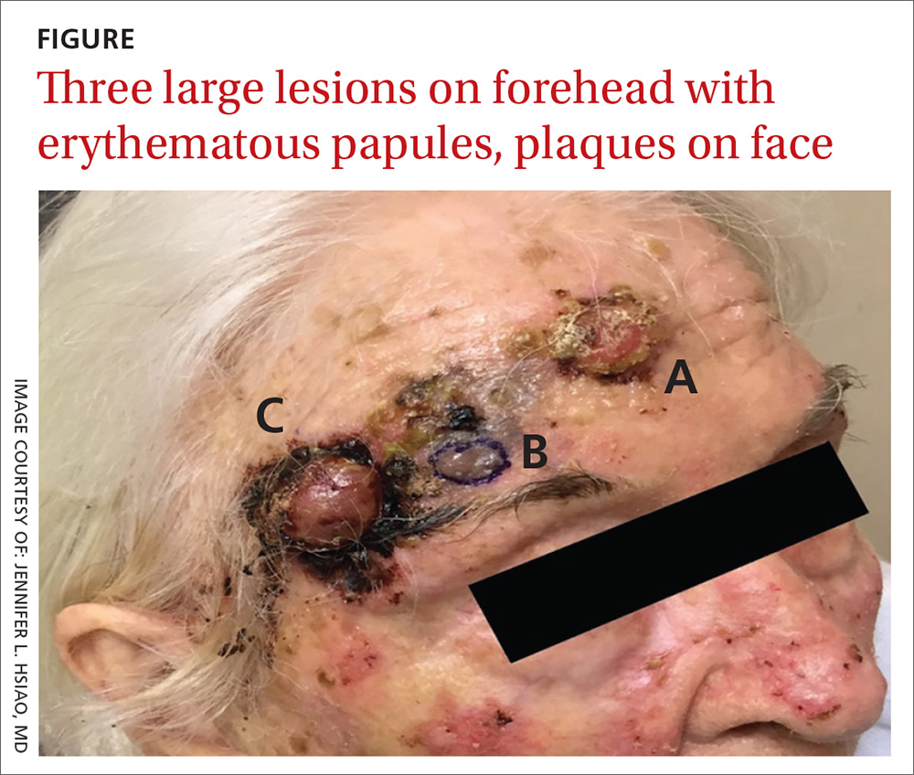 Three large lesions on forehead with erythematous papules, plaques on face 