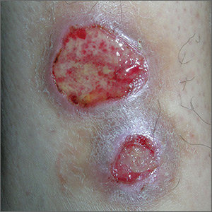 Ulcers on lower leg