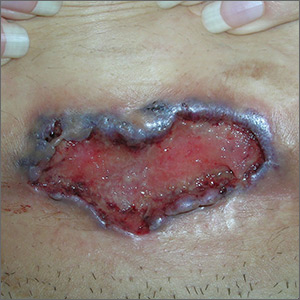 Multiple skin ulcers