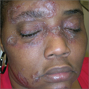 Lesions on face, arms, and legs