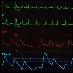 Do A-fib patients continue to benefit from vitamin K antagonists with advancing age?