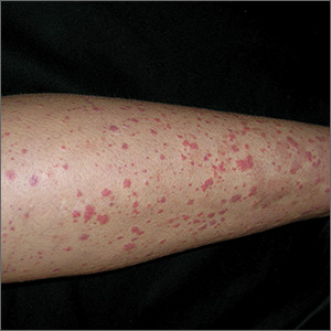 Nonthrombocytopenic purpuric rash of Henoch-SchÖnlein purpura