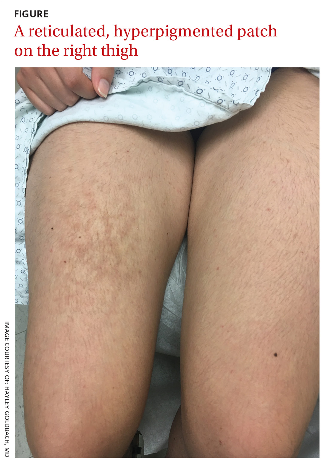 A reticulated, hyperpigmented patch on the right thigh