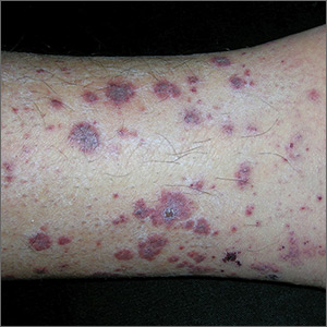 Rash on lower legs