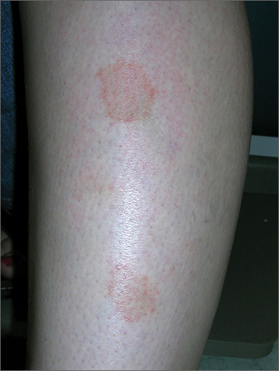 Marks on lower leg