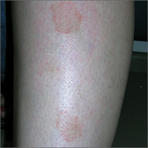 Marks on lower leg