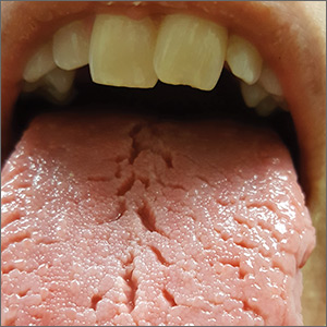 Fissured tongue in a patient with incompletely treated celiac disease