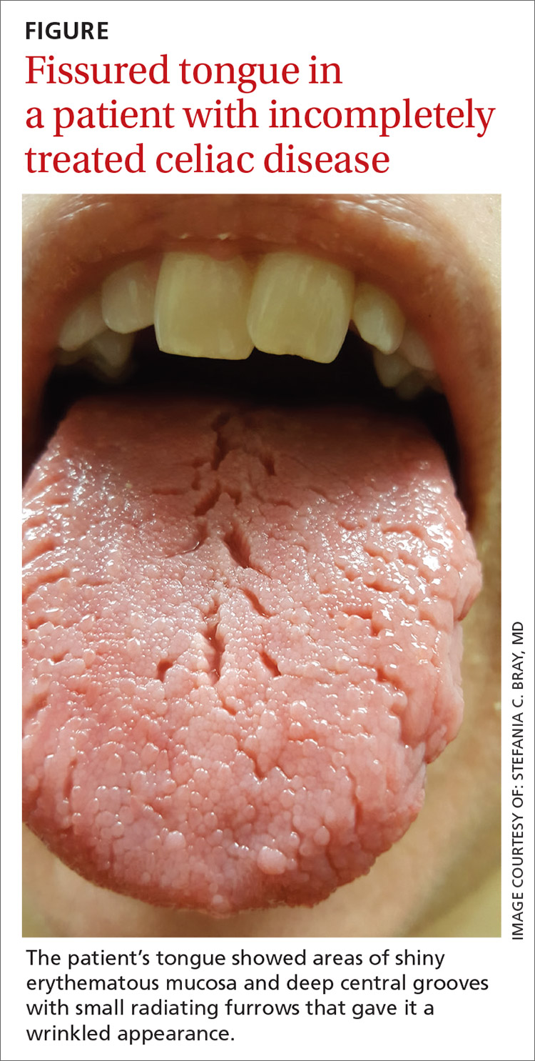 Red Patches On The Tongue With White Borders • History Of Geographic