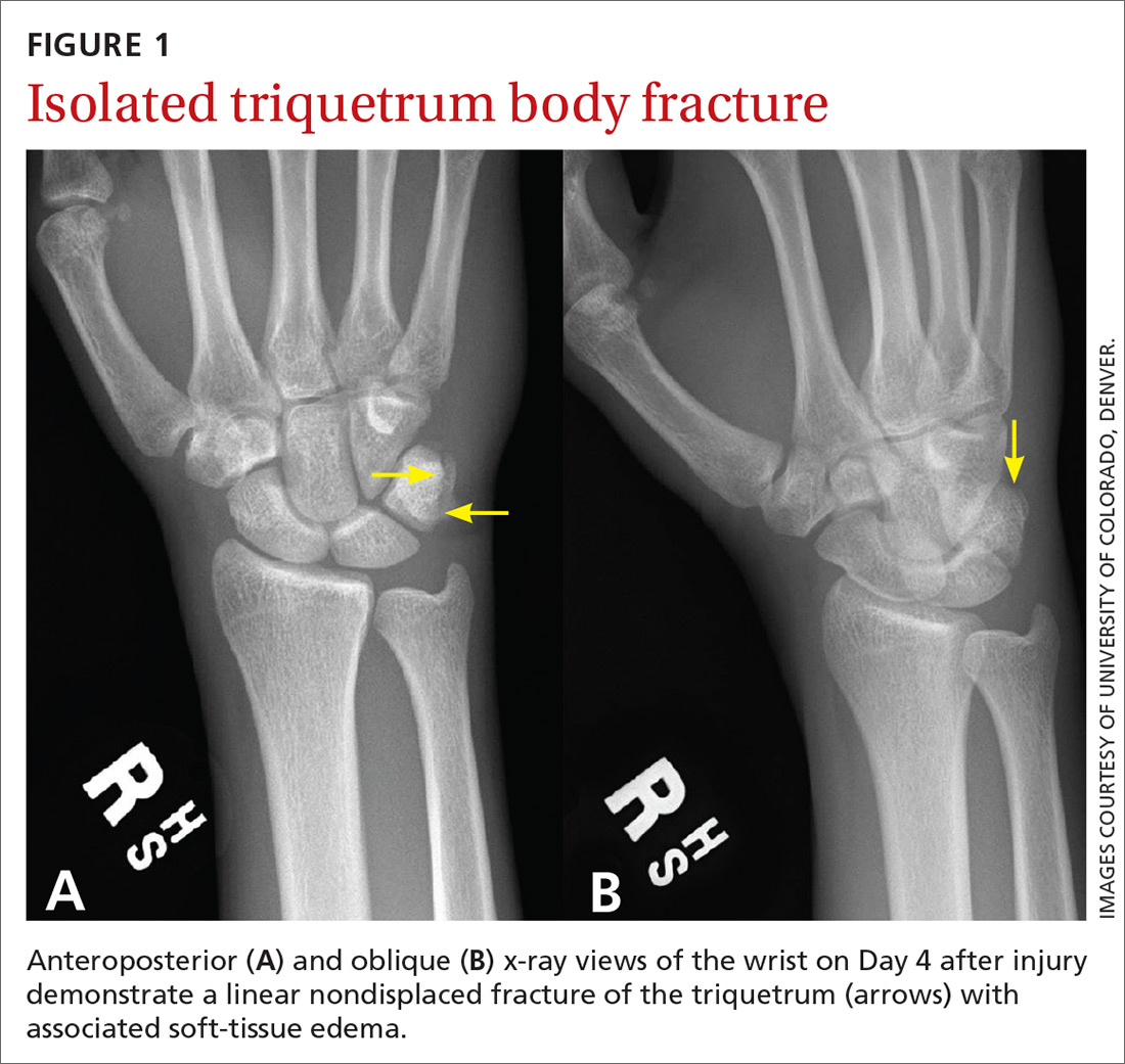 Anteroposterior (A) and oblique (B) x-ray views of the wrist on Day 4 after injury demonstrate a linear nondisplaced fracture of the triquetrum (arrows) with associated soft-tissue edema.