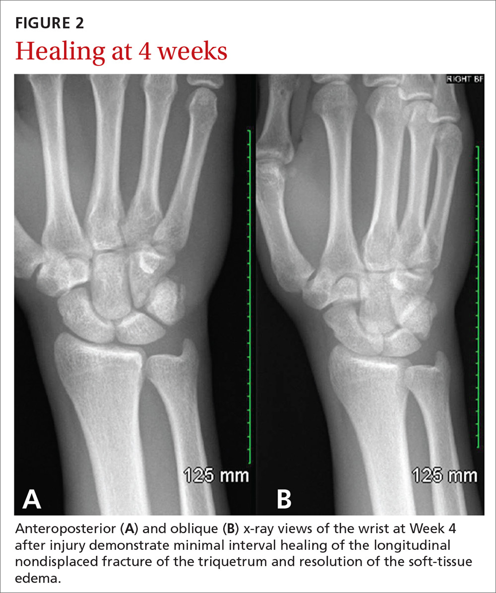 Anteroposterior (A) and oblique (B) x-ray views of the wrist at Week 4 after injury demonstrate minimal interval healing of the longitudinal nondisplaced fracture of the triquetrum and resolution of the soft-tissue edema.