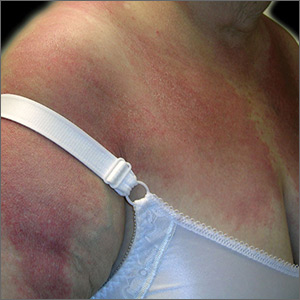 Erythema and scale over the shawl distribution