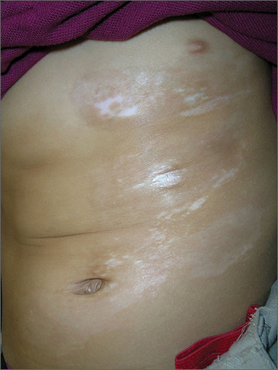 Skin changes on abdomen