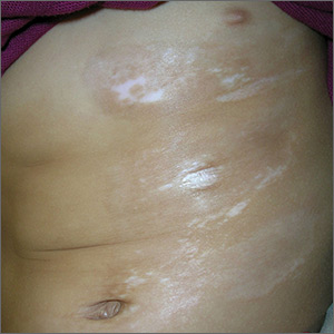 Skin changes on abdomen