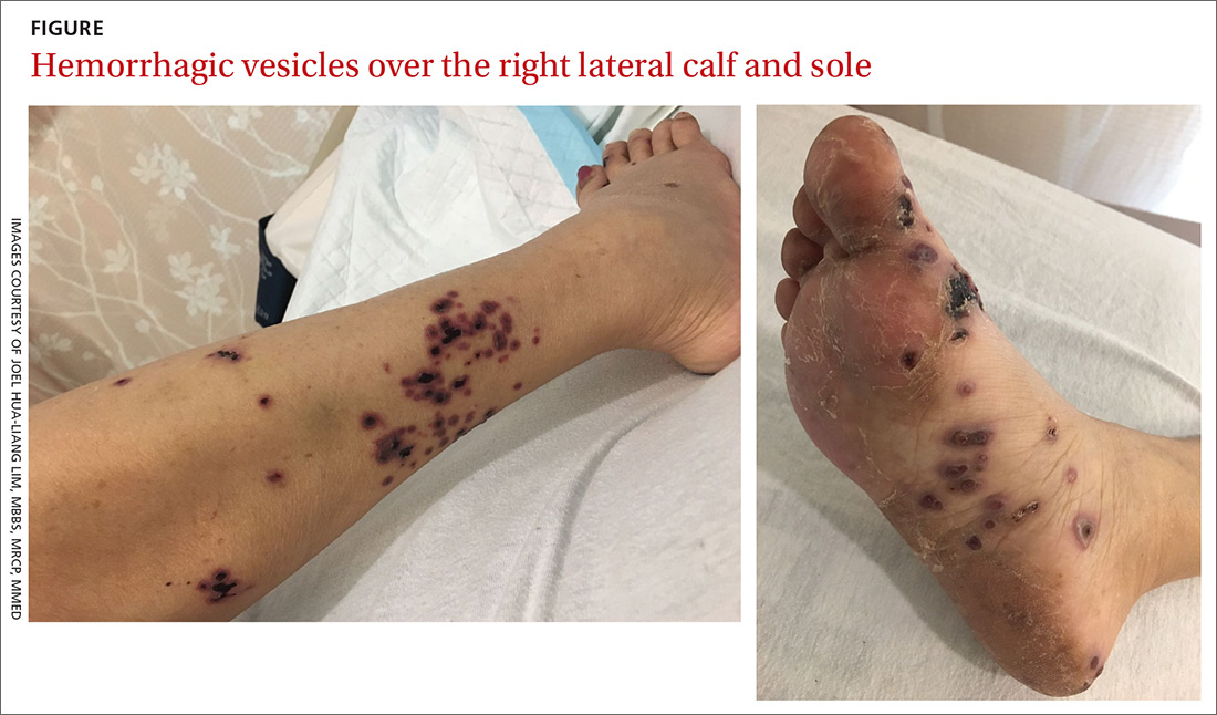 Hemorrhagic vesicles over the right lateral calf and sole