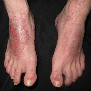 Red patches and thin plaques on feet