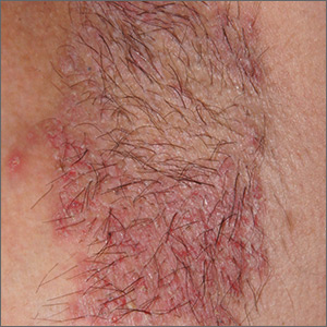 Rash on axilla