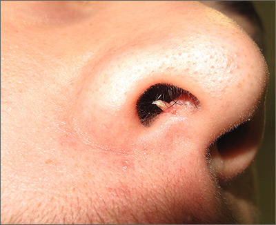 nasal papilloma growth