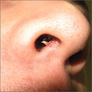 Growth in right nostril