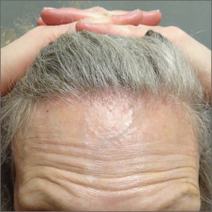 Symmetric hair loss across frontal scalp