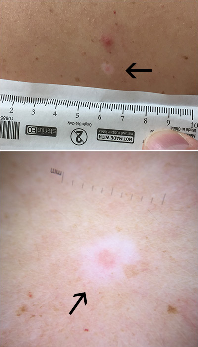 a mole with white dot