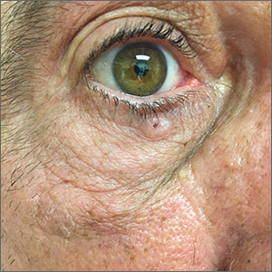 Pigmented lesion on face