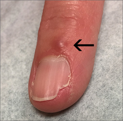 Fingernail Deformity Mdedge Family Medicine