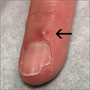 Fingernail deformity