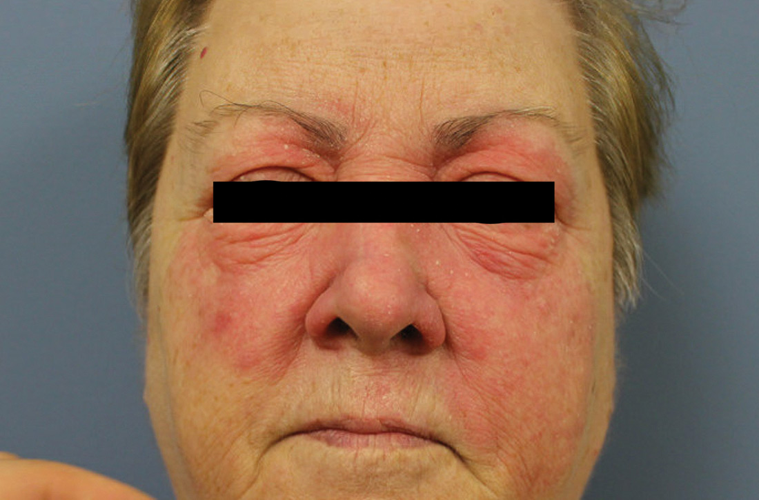 A large asymptomatic facial rash