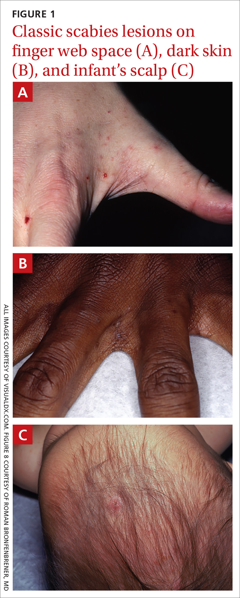 Scabies Rash on Black Skin: Symptoms and Treatment