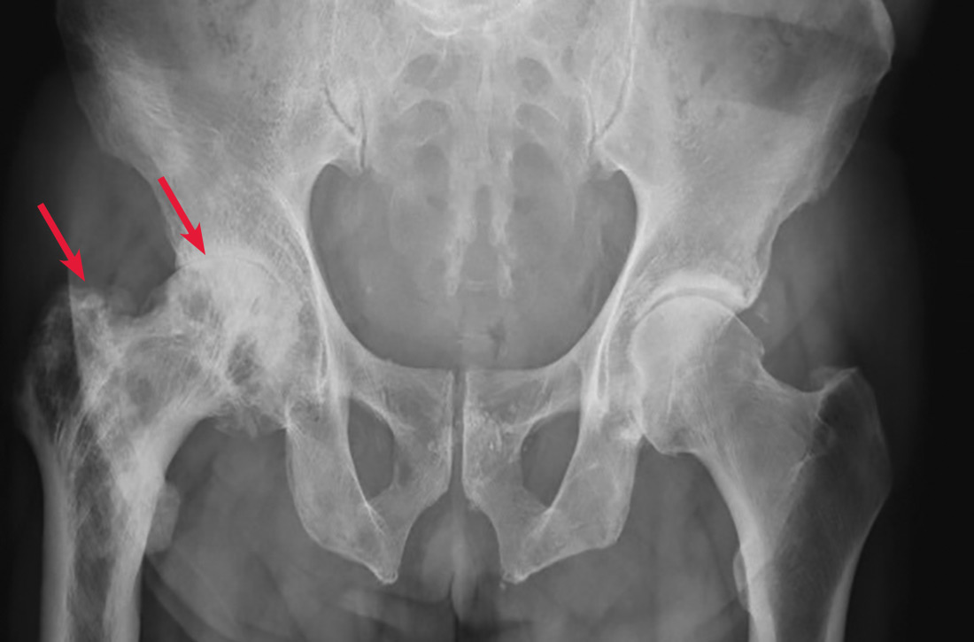 A coarsened trabecular pattern and mild bony enlargement of the right femoral head, neck, and diaphysis