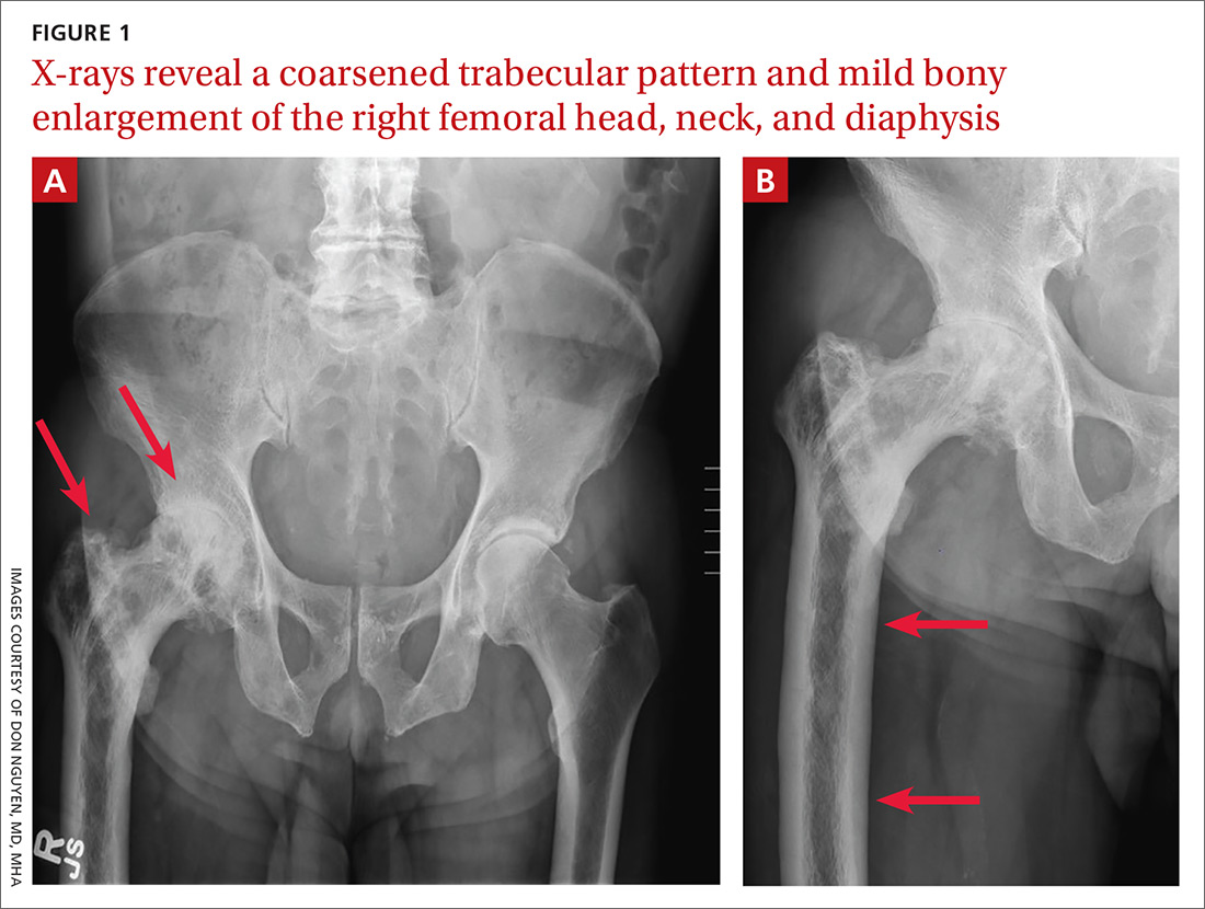 X-rays reveal a coarsened trabecular pattern and mild bony enlargement of the right femoral head, neck, and diaphysis