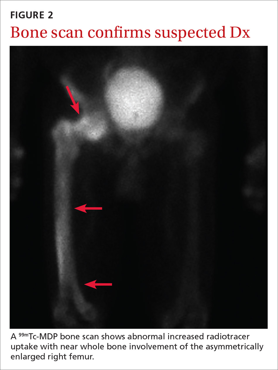 Bone scan confirms suspected Dx