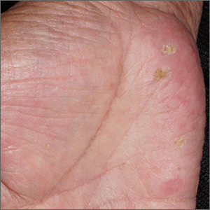 Papules on hand