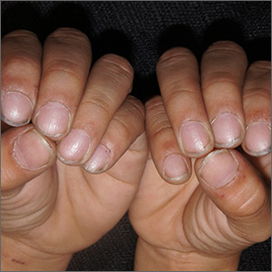 Pitting of fingernails