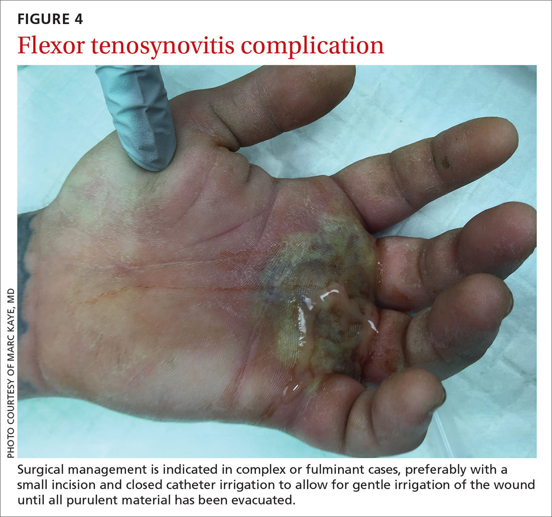 Flexor tenosynovitis complication