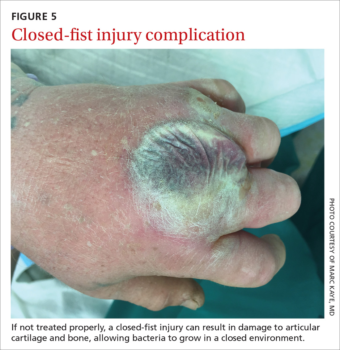 Closed-fist injury complication